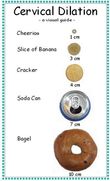 What is 1 cm Dilated and 50% Effaced