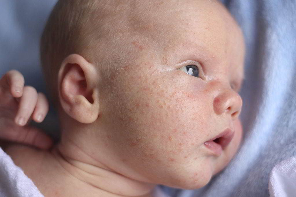how long does a baby acne last